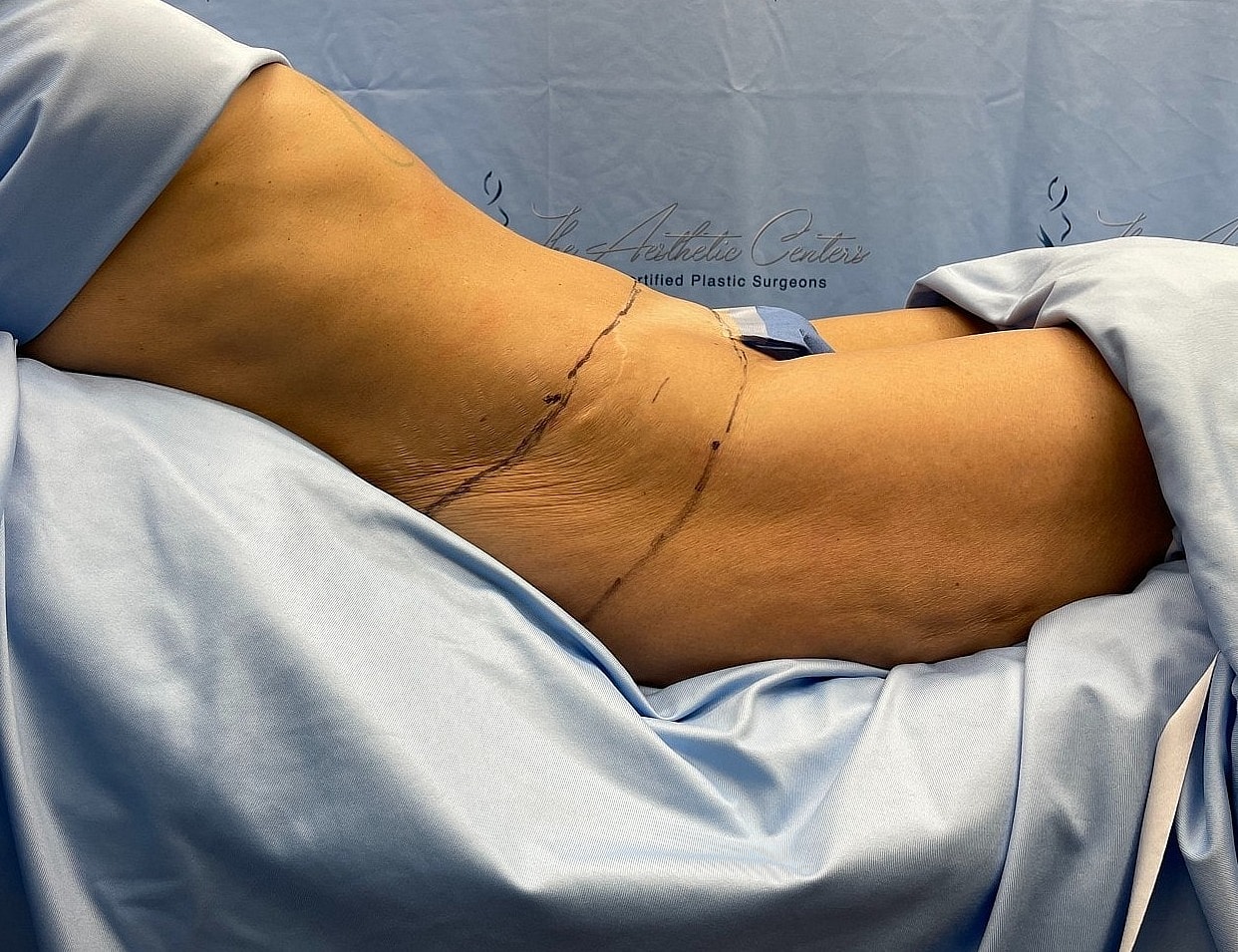 Surgical site on a patient's abdomen.