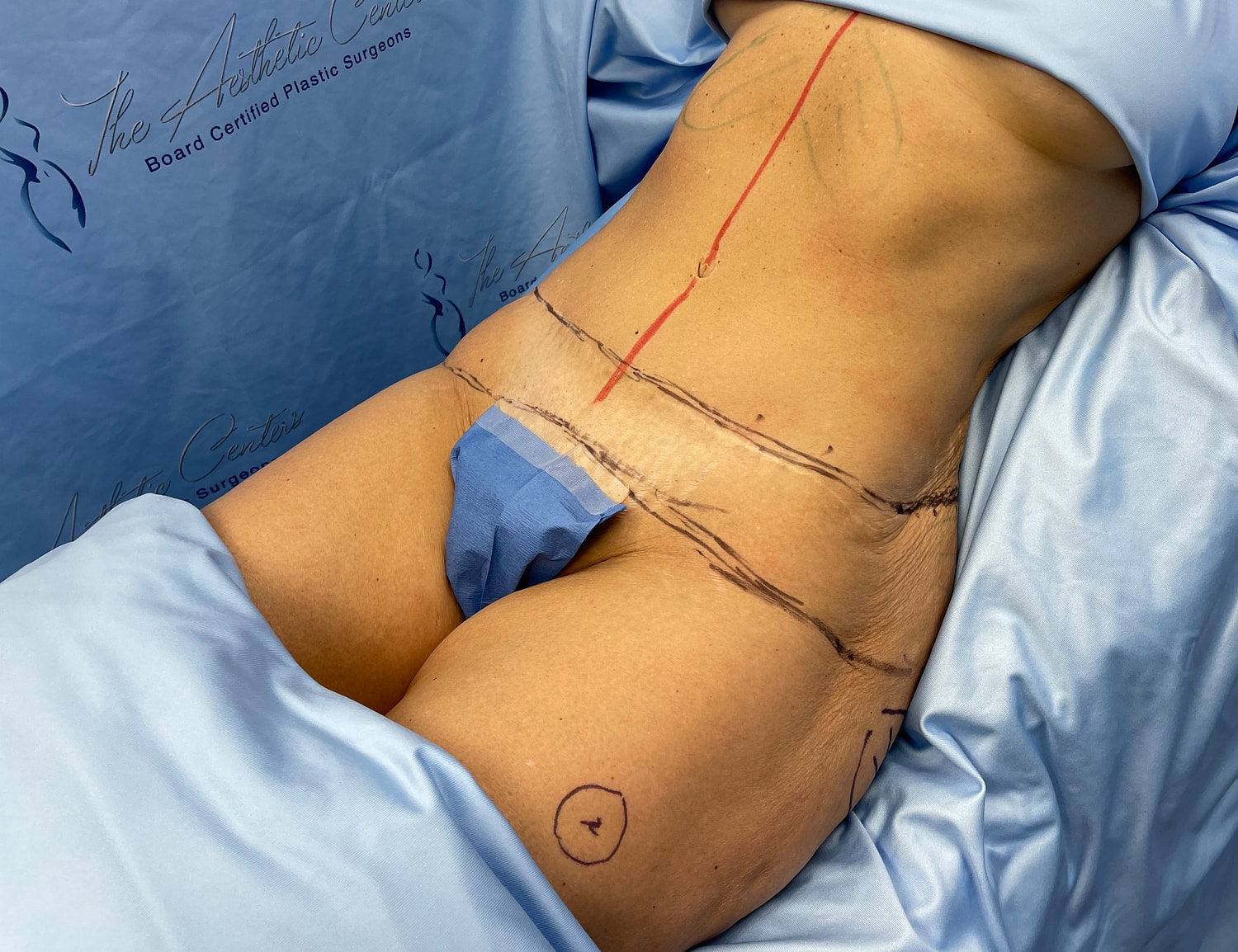 Surgical markings on abdomen for cosmetic procedure.