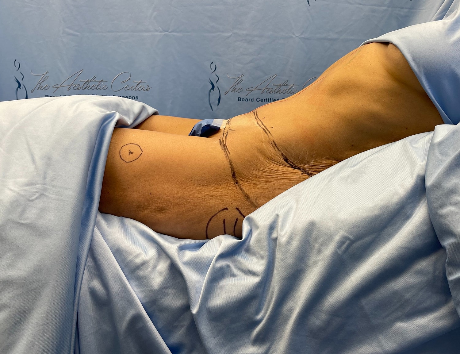Patient preparation for surgical procedure, marked area.