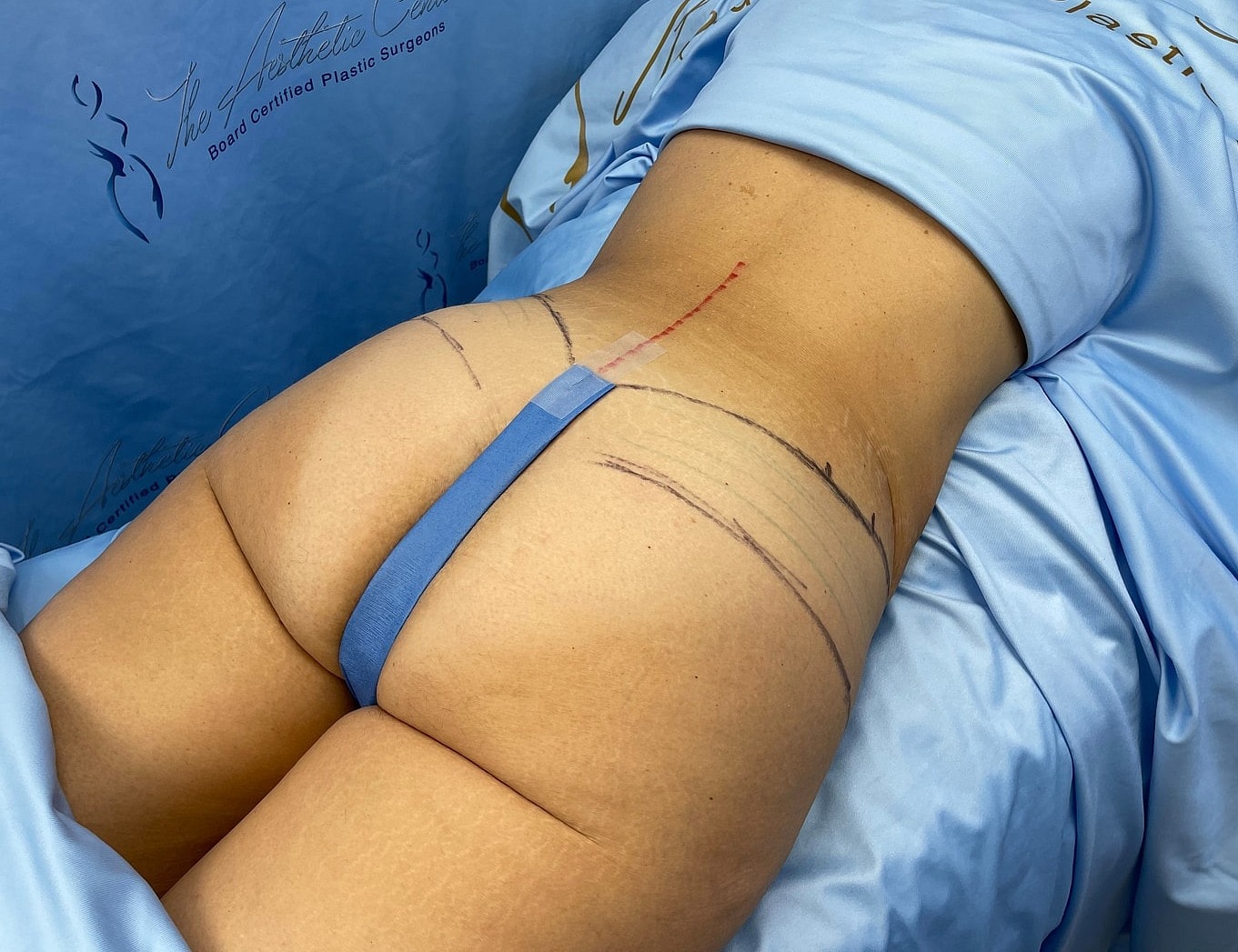 Patient preparation for cosmetic surgery procedure.