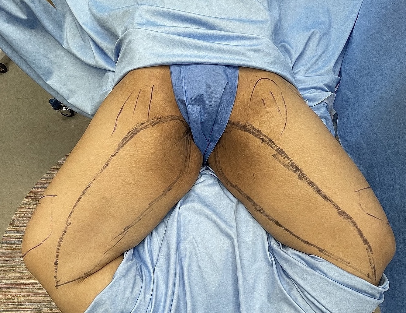 Patient's thighs marked for surgical procedure.