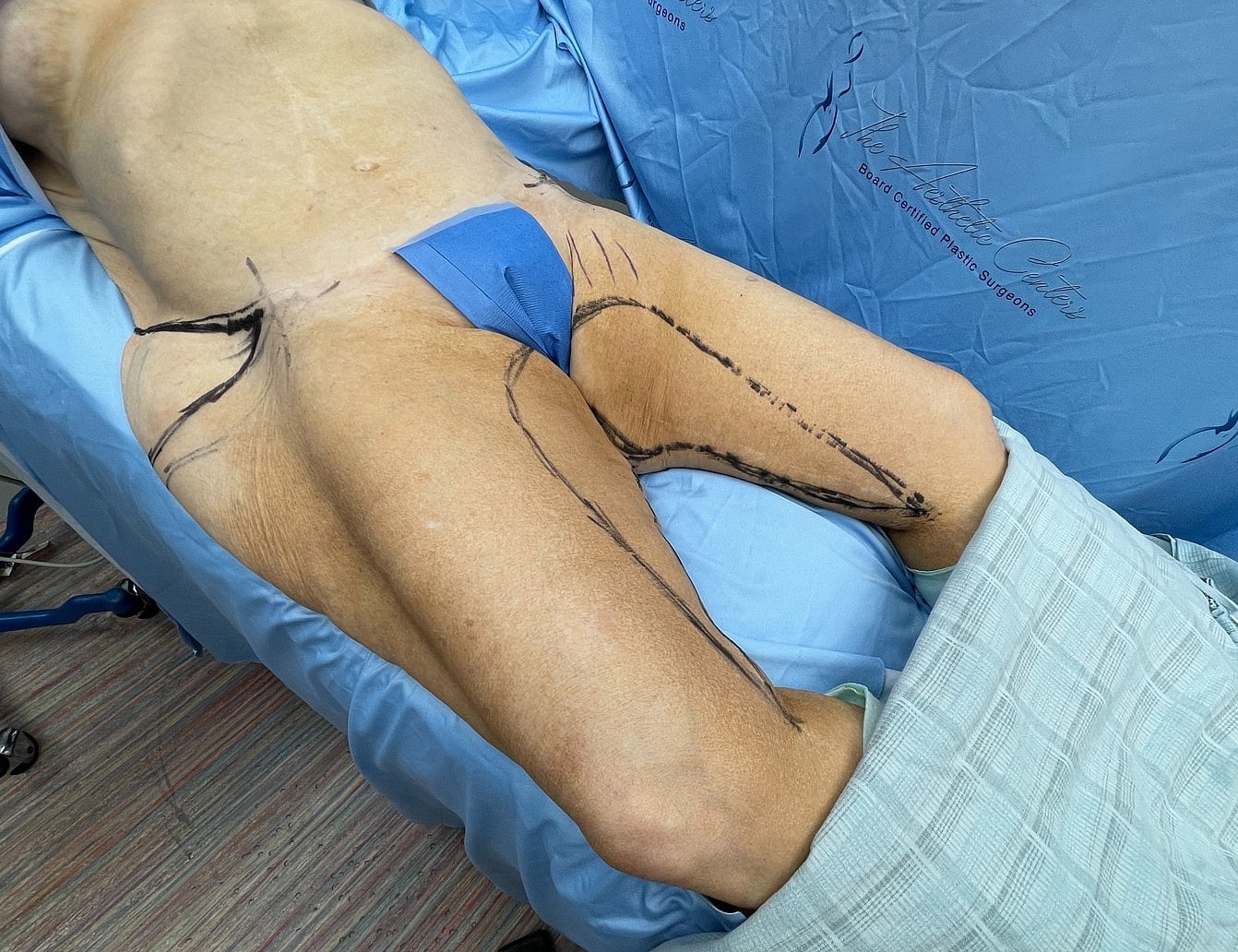 Surgical markings on patient's leg pre-operation.