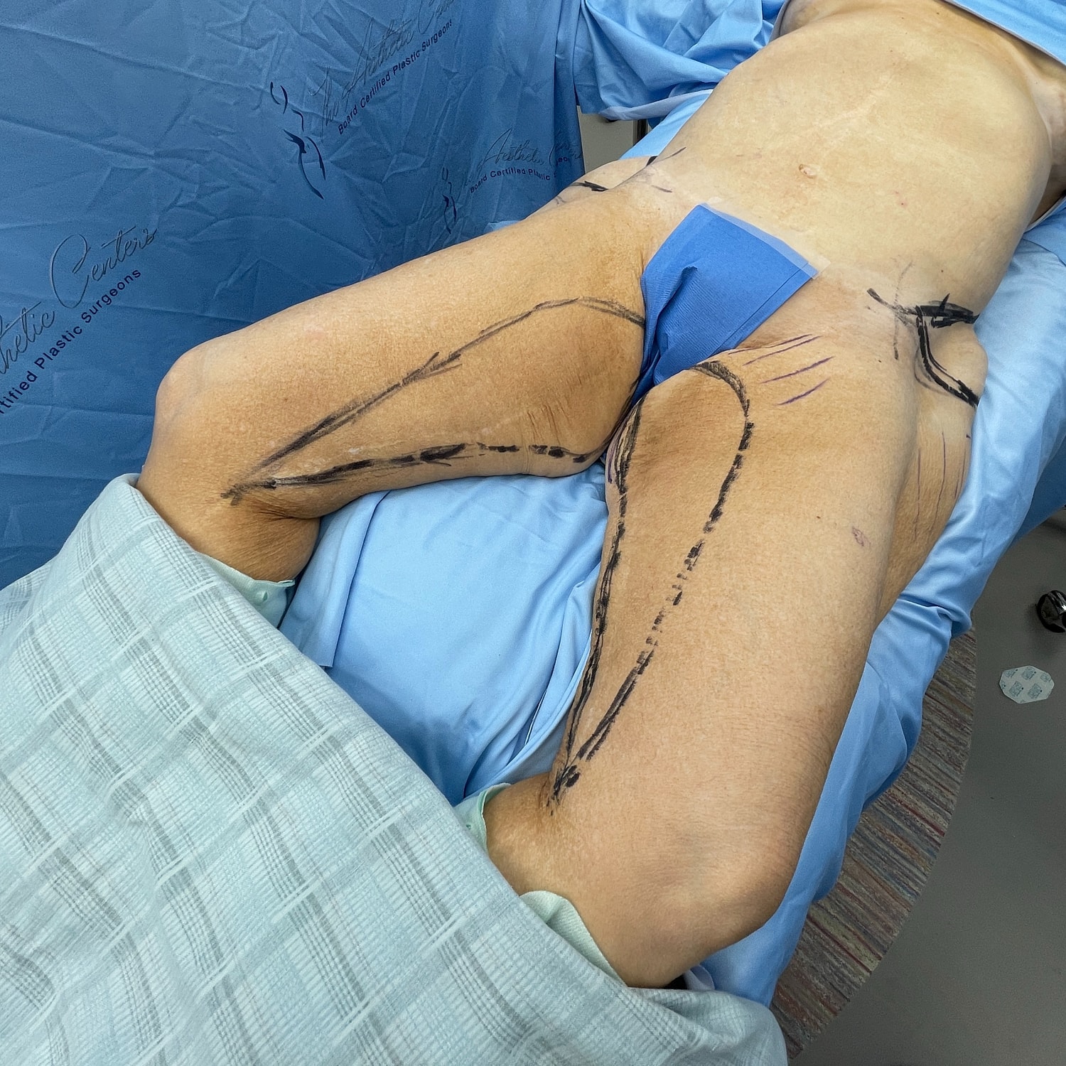 Patient preparation for surgical procedure on legs.