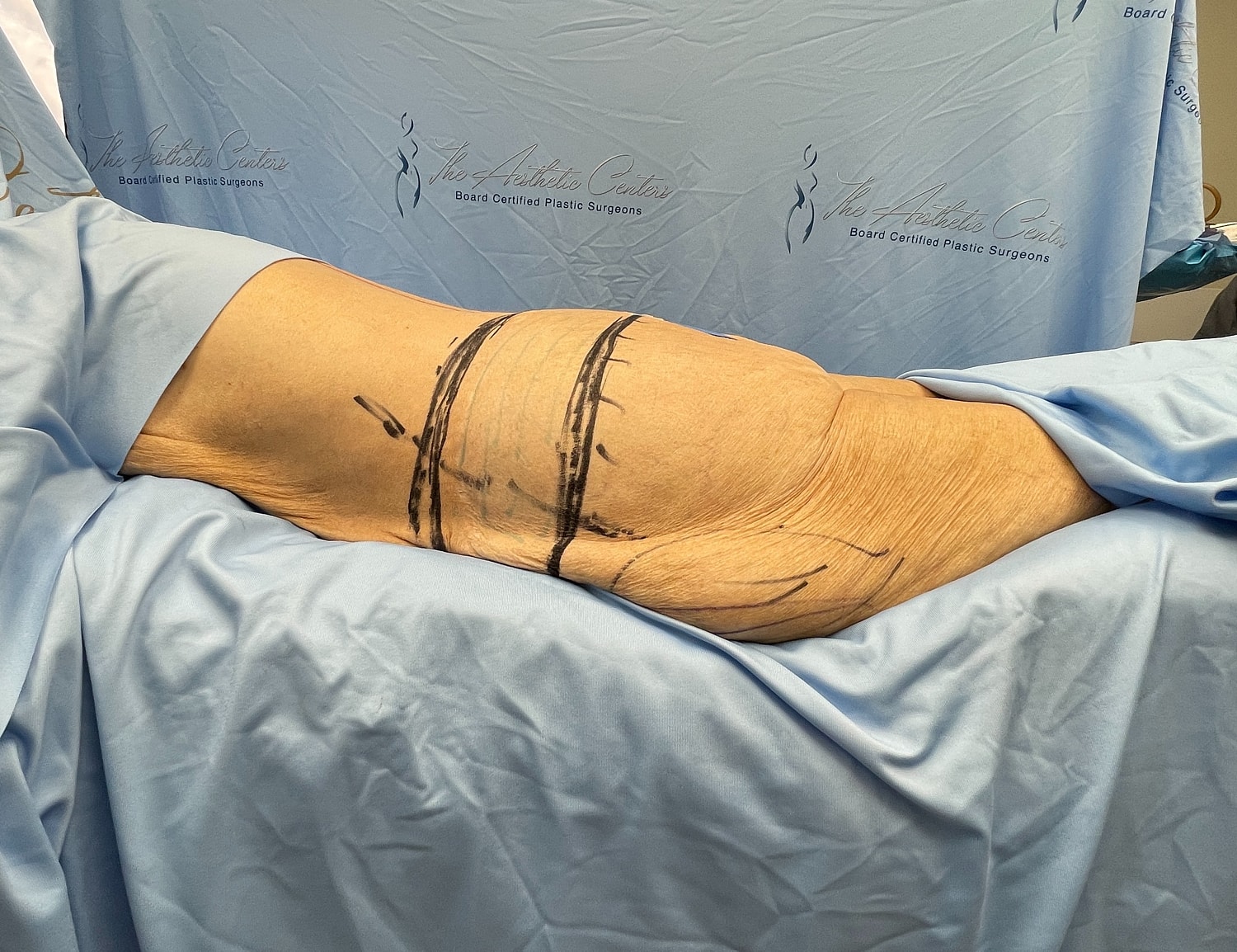 Marked area on patient’s body for procedure.
