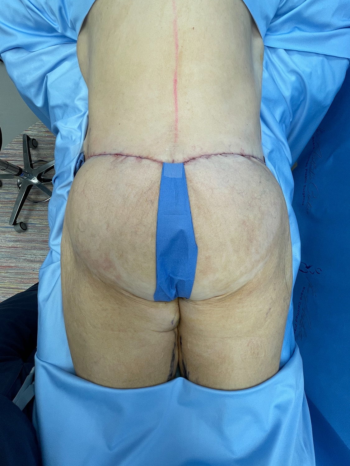 Post-surgery view of a patient's back area.