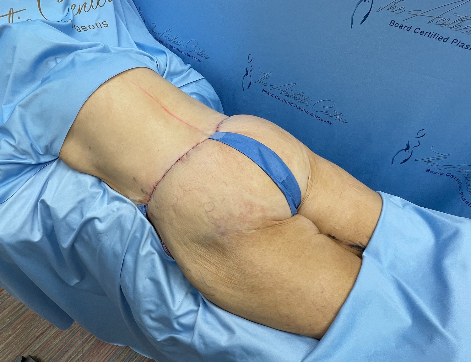 Post-surgery recovery for cosmetic procedure.