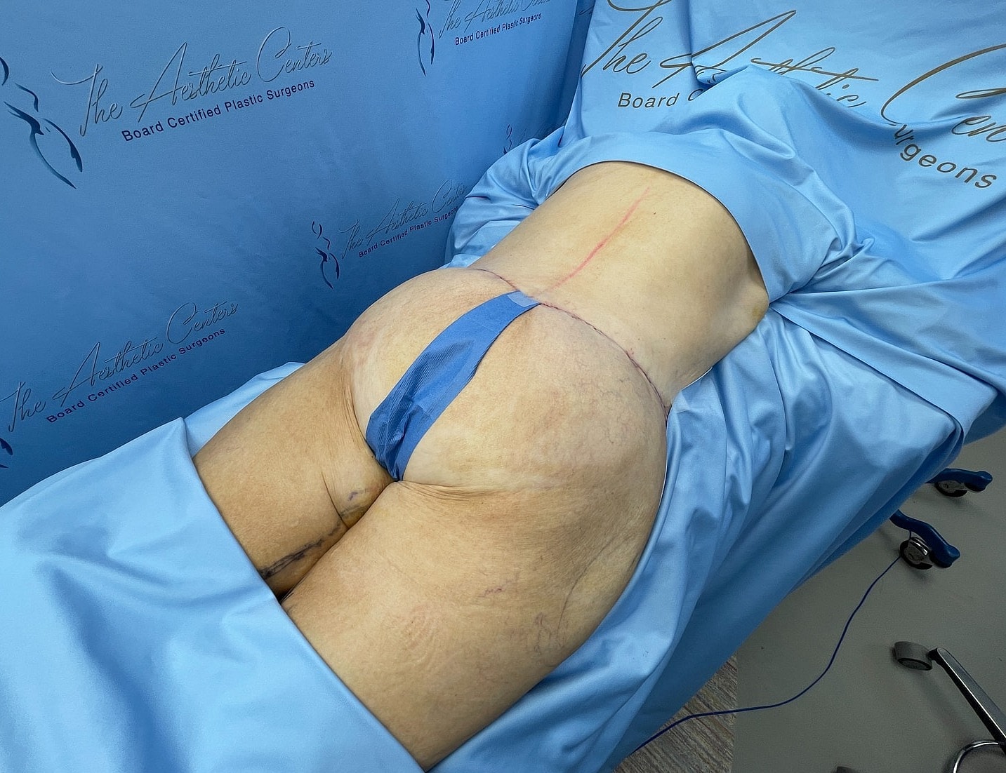 Surgical preparation for body contouring procedure.