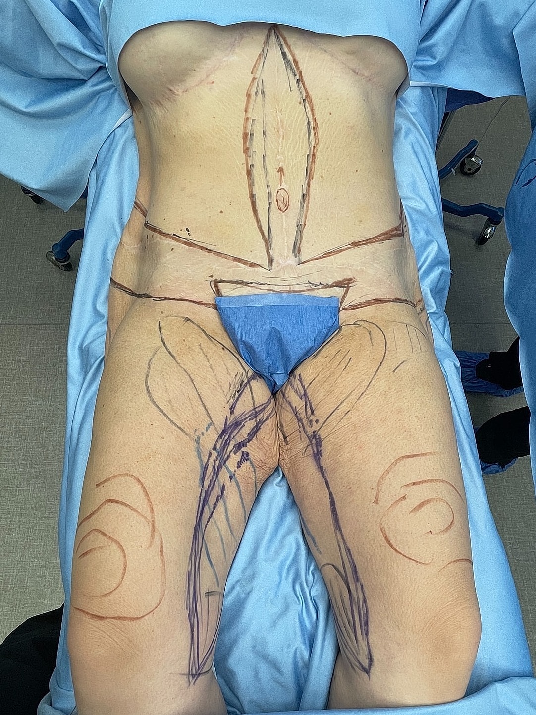 Surgical markings on patient’s abdomen and thighs.