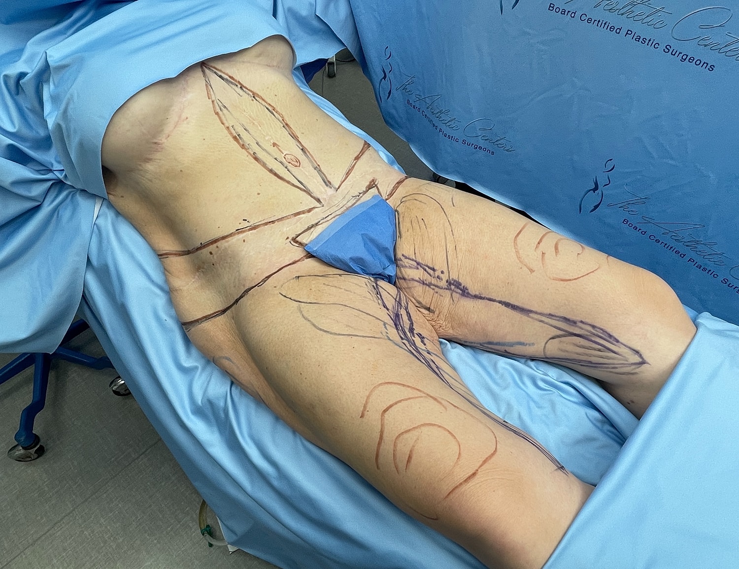 Patient prepped for surgical procedure on lower body.