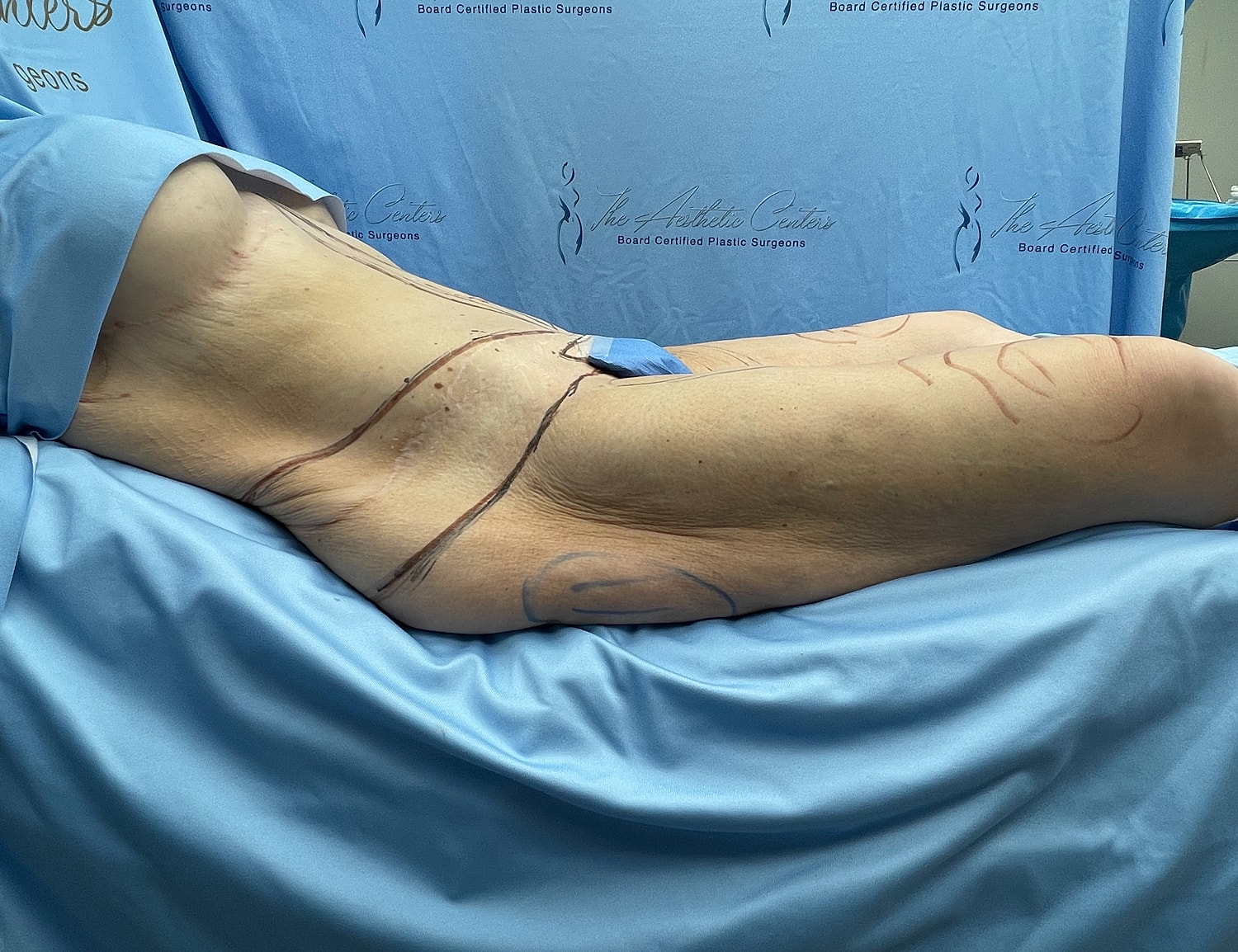 Body contouring procedure preparation with markings.