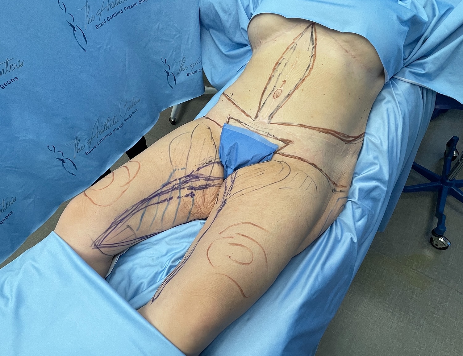 Surgical markings on patient before procedure.