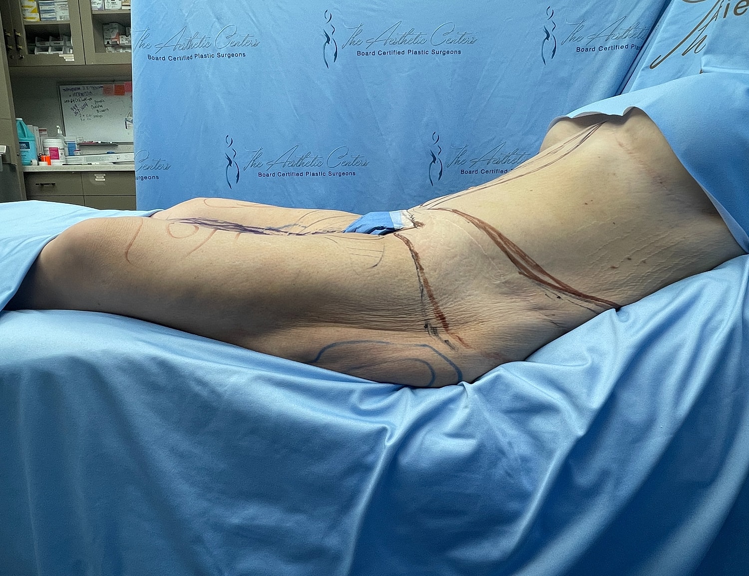 Patient preparation for cosmetic surgery procedure.