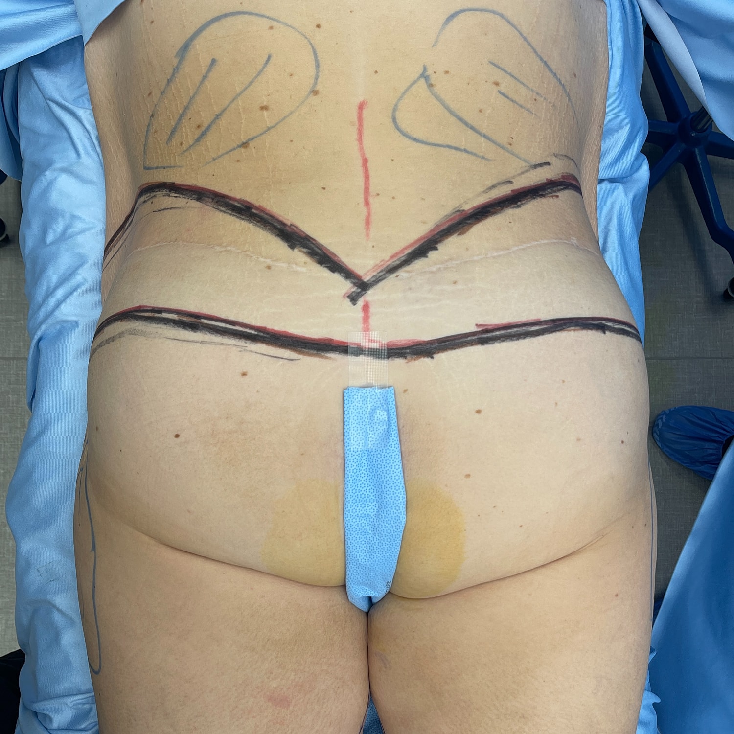 Patient with markings for surgical procedure preparation.