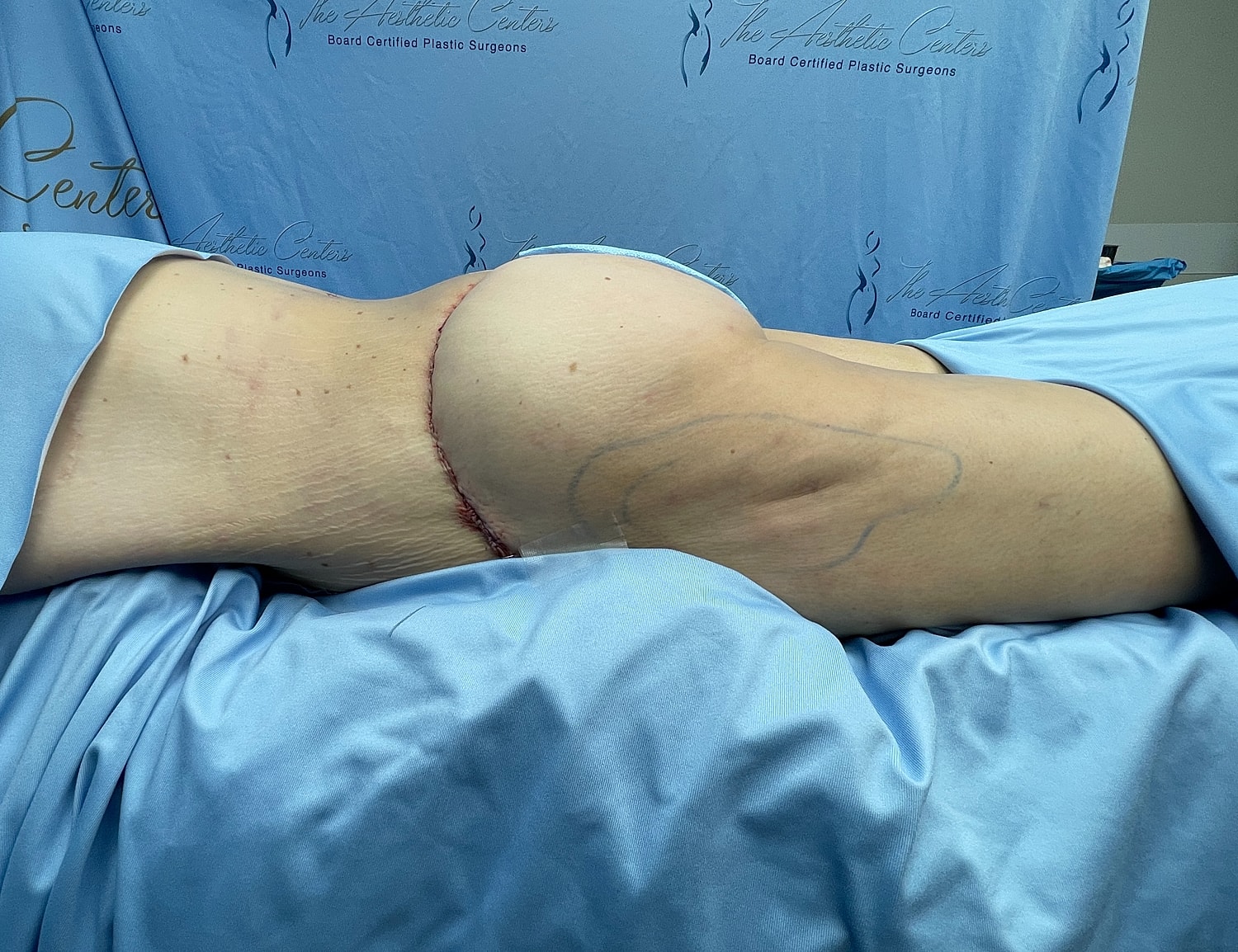 Patient recovering after surgical procedure, side view.