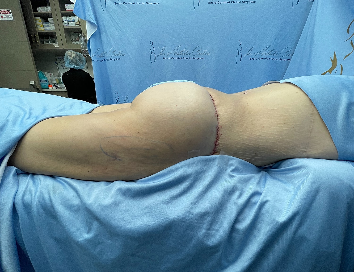 Surgical procedure recovery with visible incision site.