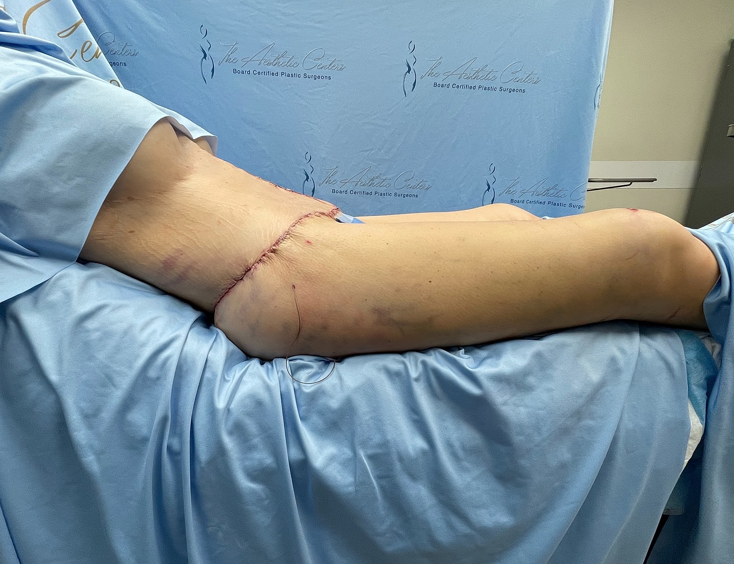 Sutured arm after surgical procedure.