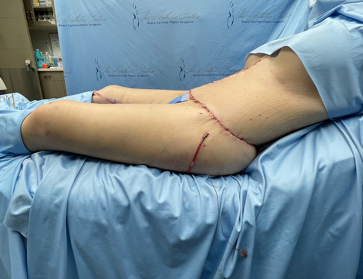 Post-surgical site on patient’s thigh.