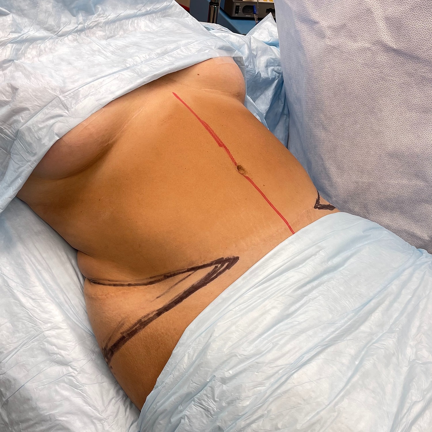 Surgical markings on patient's abdomen before procedure.