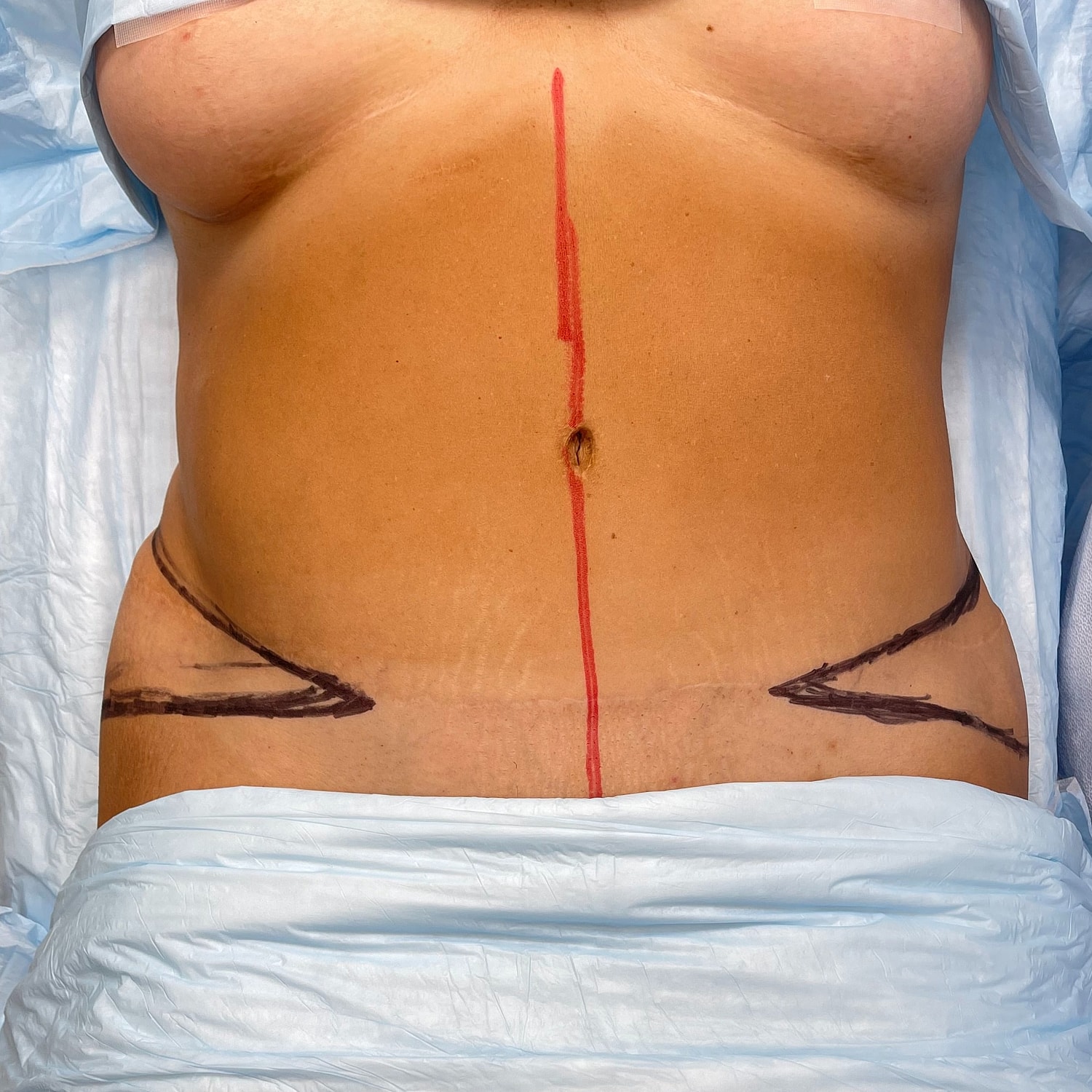 Marked abdomen preparing for surgical procedure