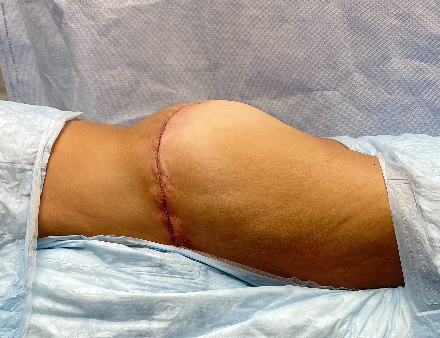Post-surgical knee with stitches on skin.