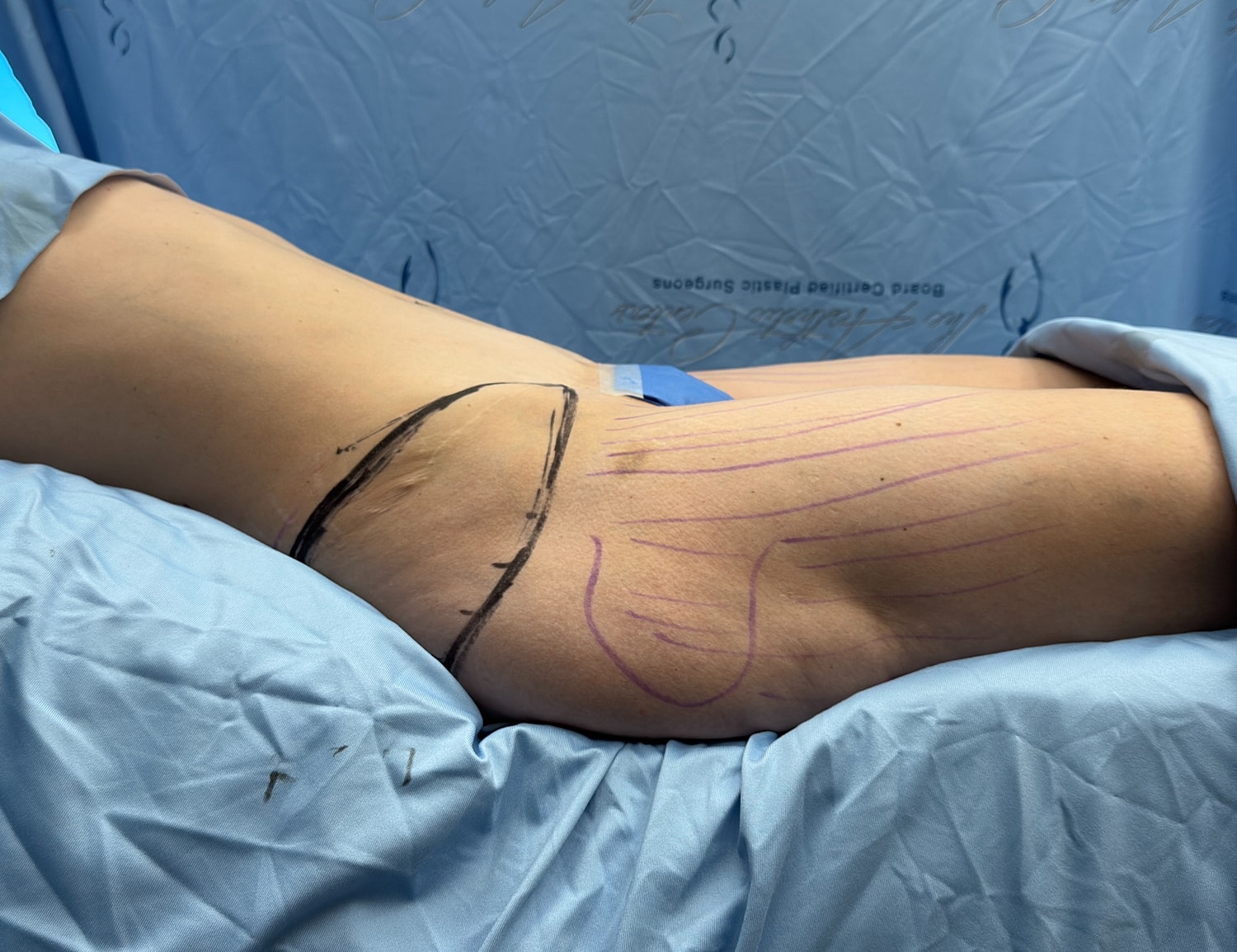 Body contouring markings on patient’s side.