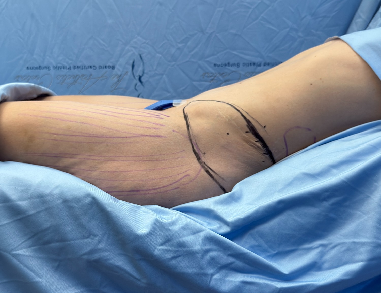 Surgical markings on a patient's side.