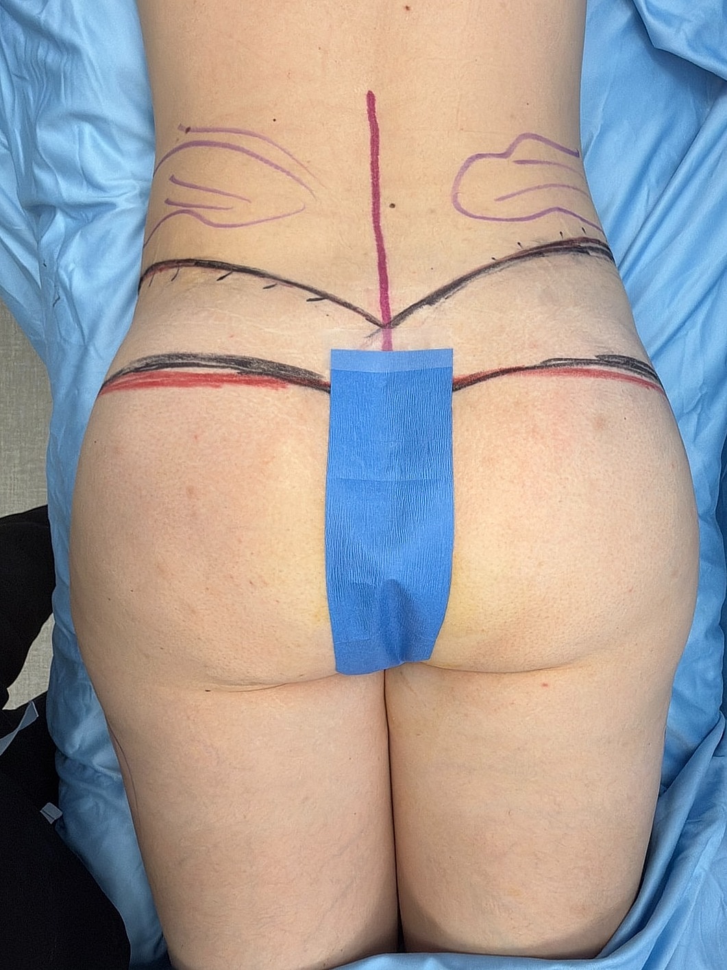 Body marking preparation for a medical procedure.