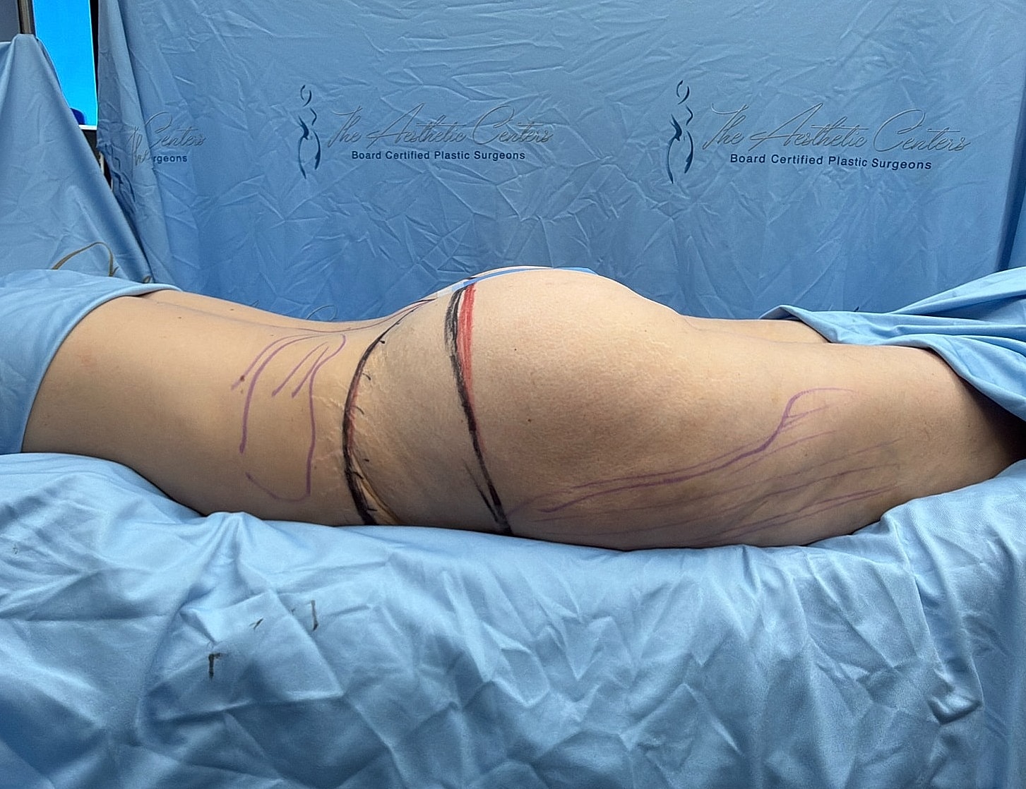 Body contouring procedure in a clinical setting.