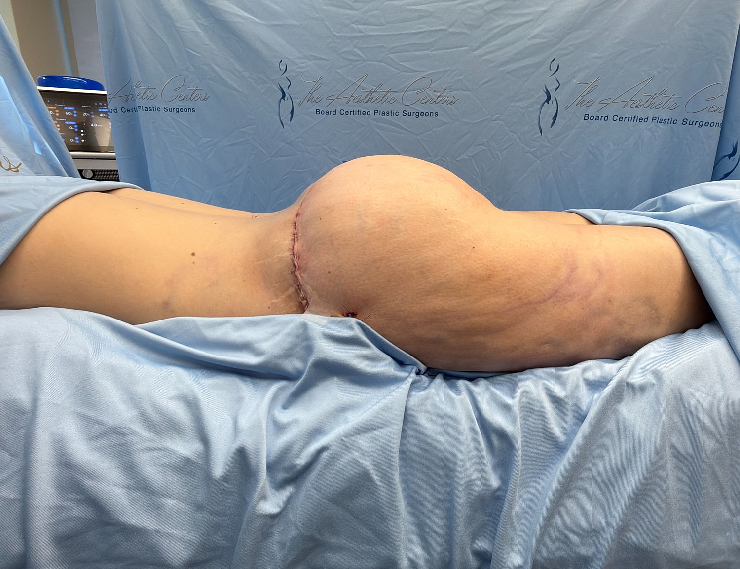 Post-surgery view of body contouring procedure.