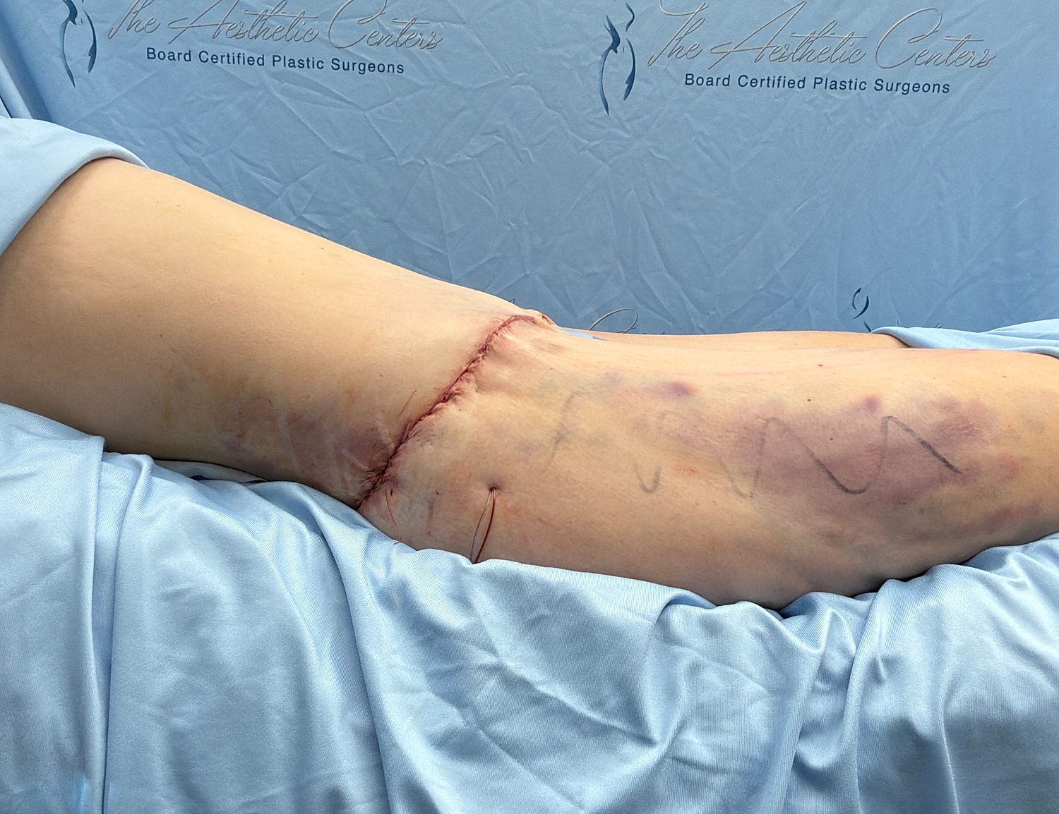 Surgical scar on patient’s thigh post-operation.