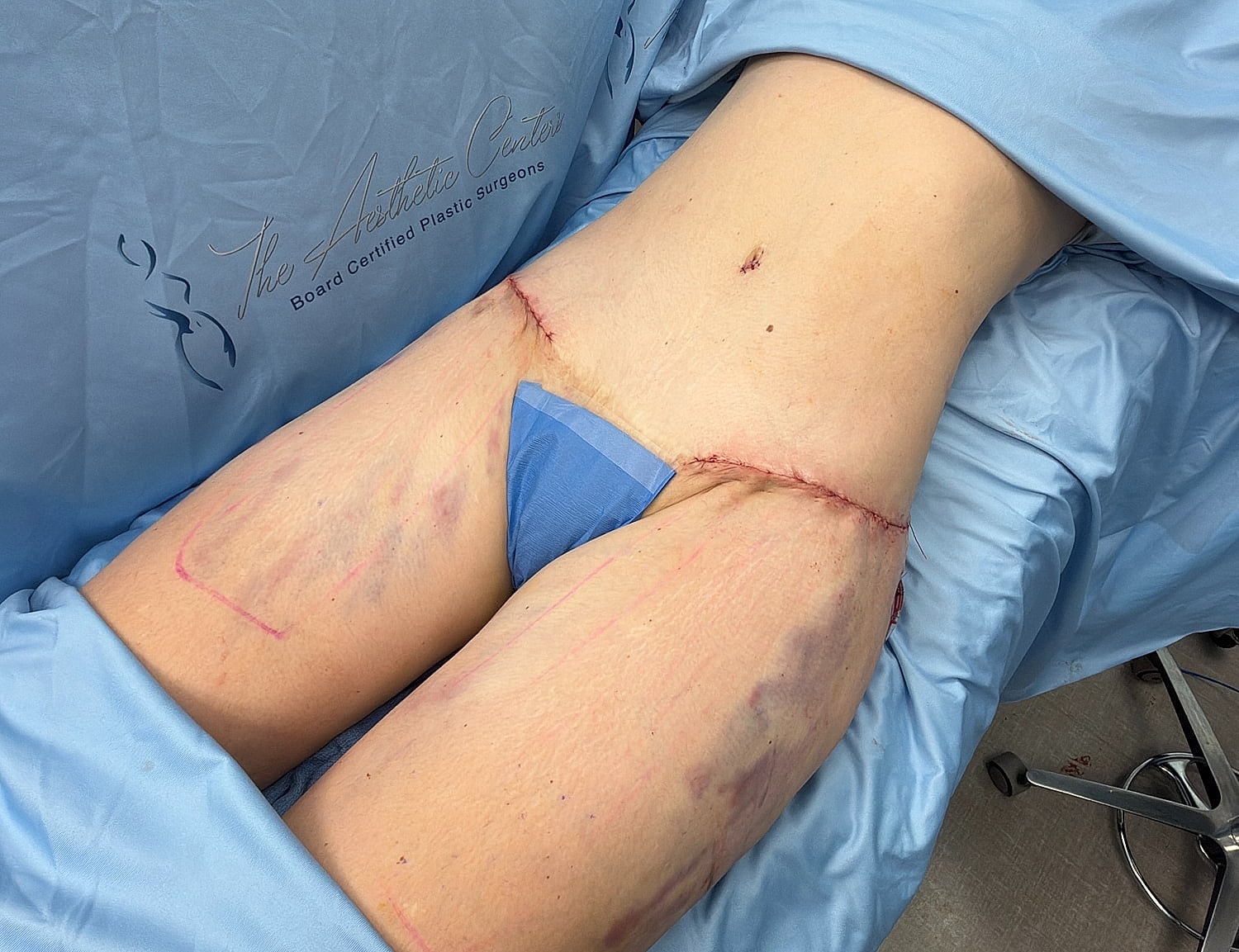 Post-surgery view of thigh procedure.