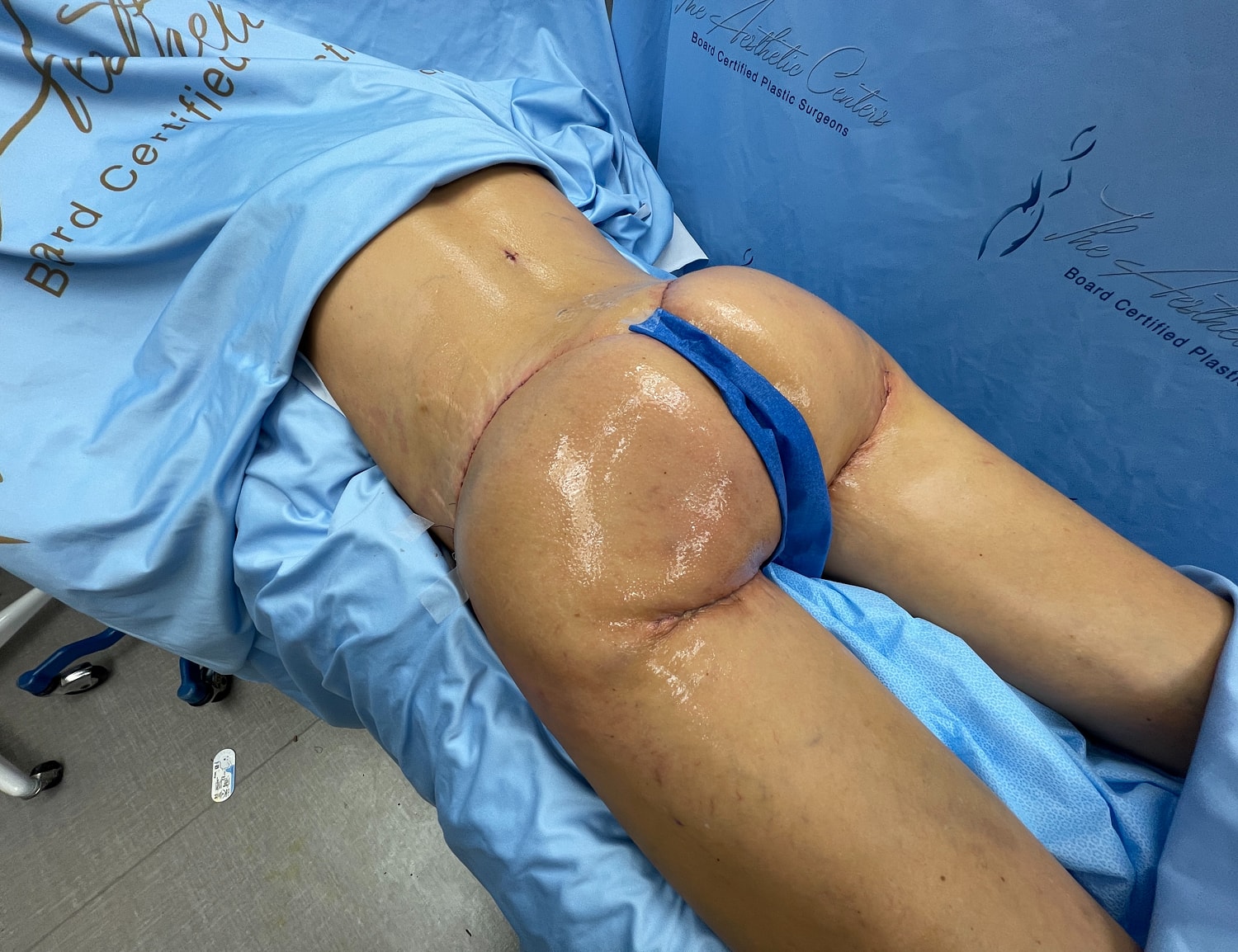 Surgical procedure on lower body, post-operation view.