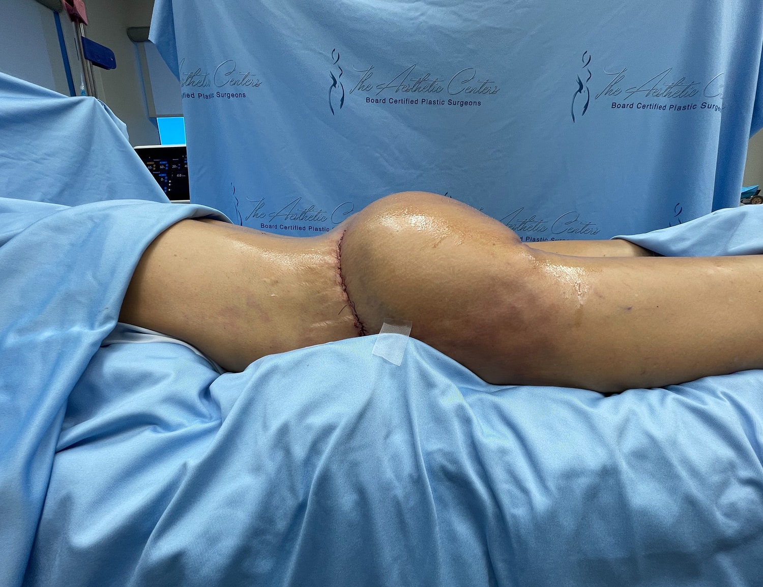 Patient's leg post-surgery on operating table.