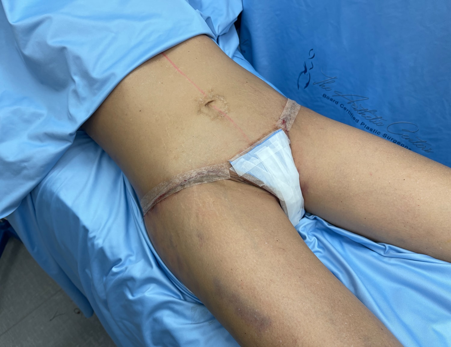 Post-surgery abdomen with medical dressing.