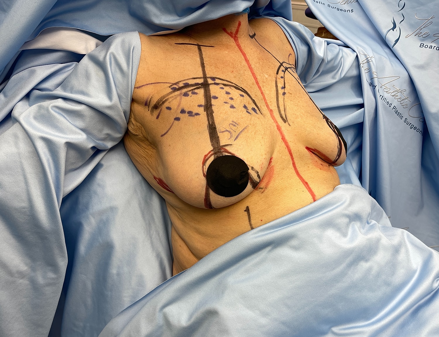 Surgical markings on a patient before procedure.