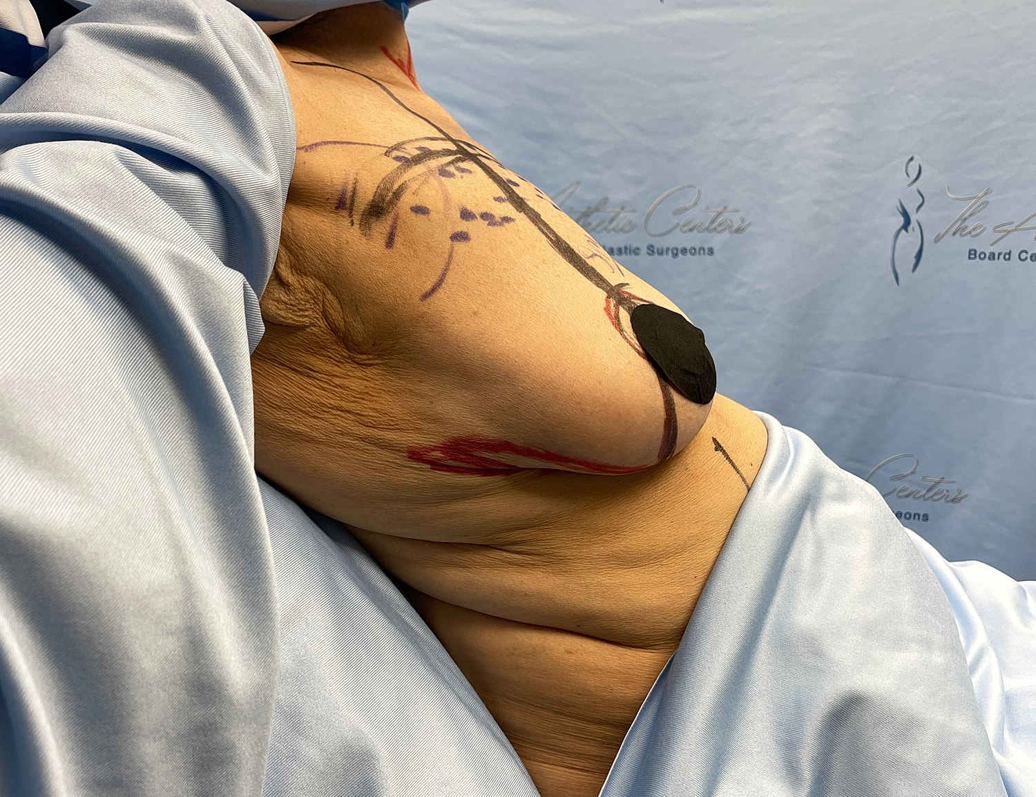 Surgical markings on patient for aesthetic procedure.
