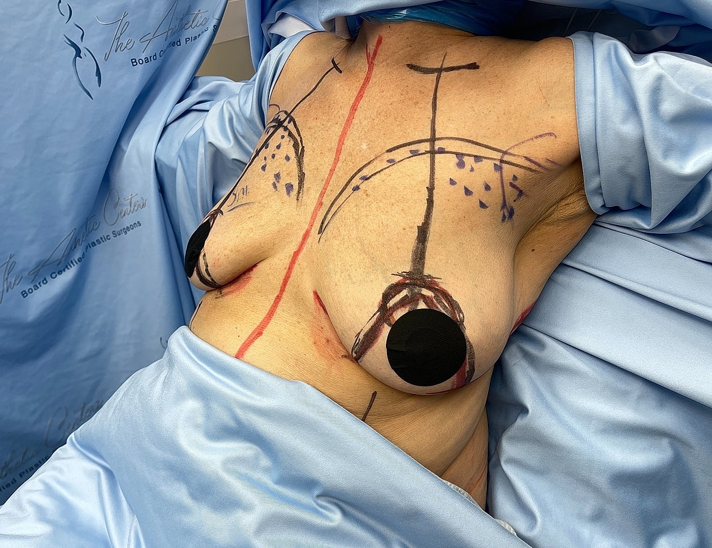 Pre-surgery markings on a patient's chest.