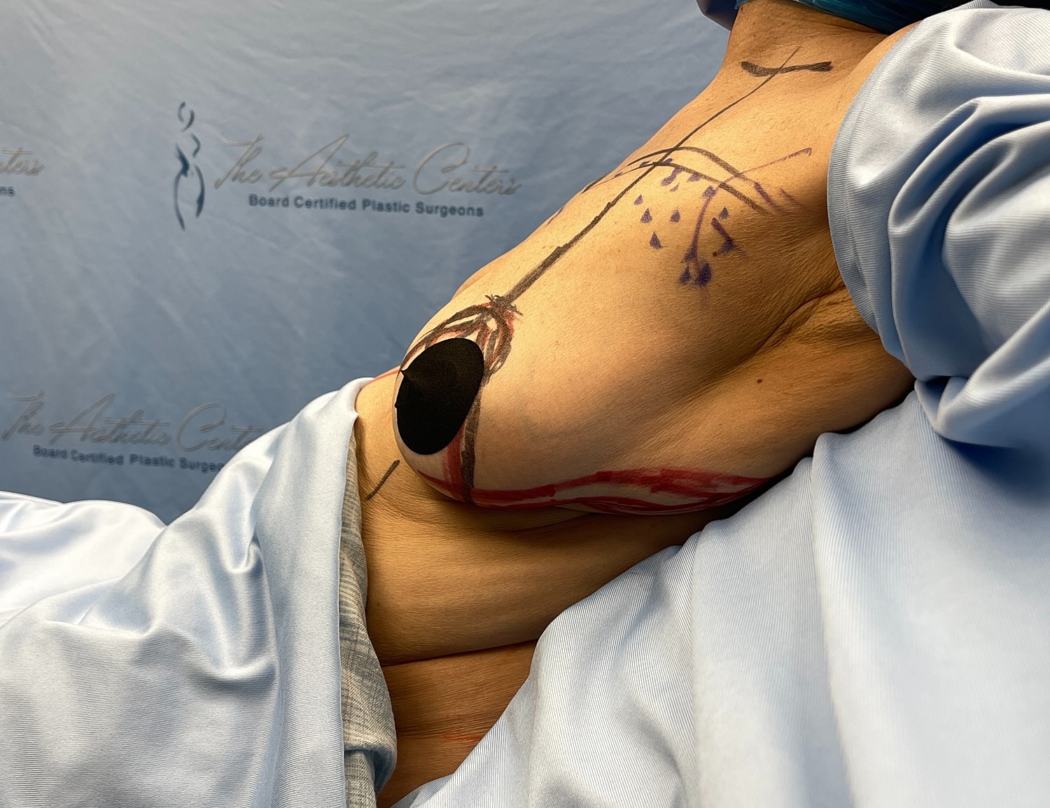Surgical markings on skin for procedure preparation.