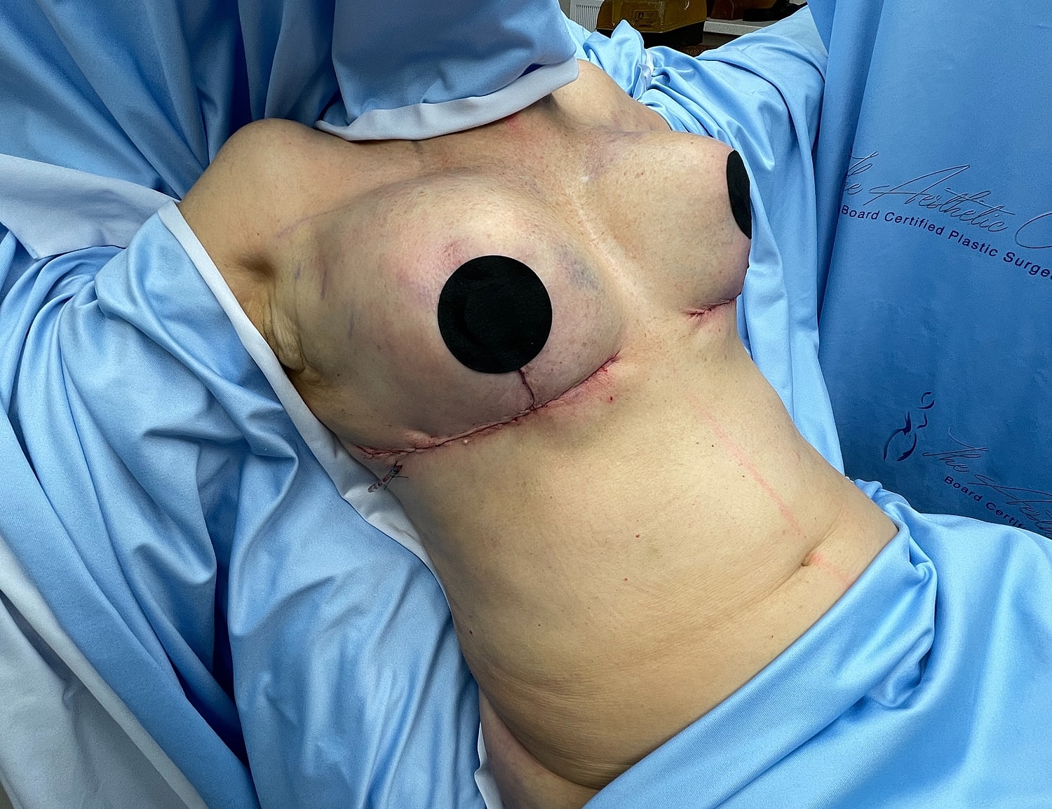 Post-surgery breast reconstruction with visible sutures.