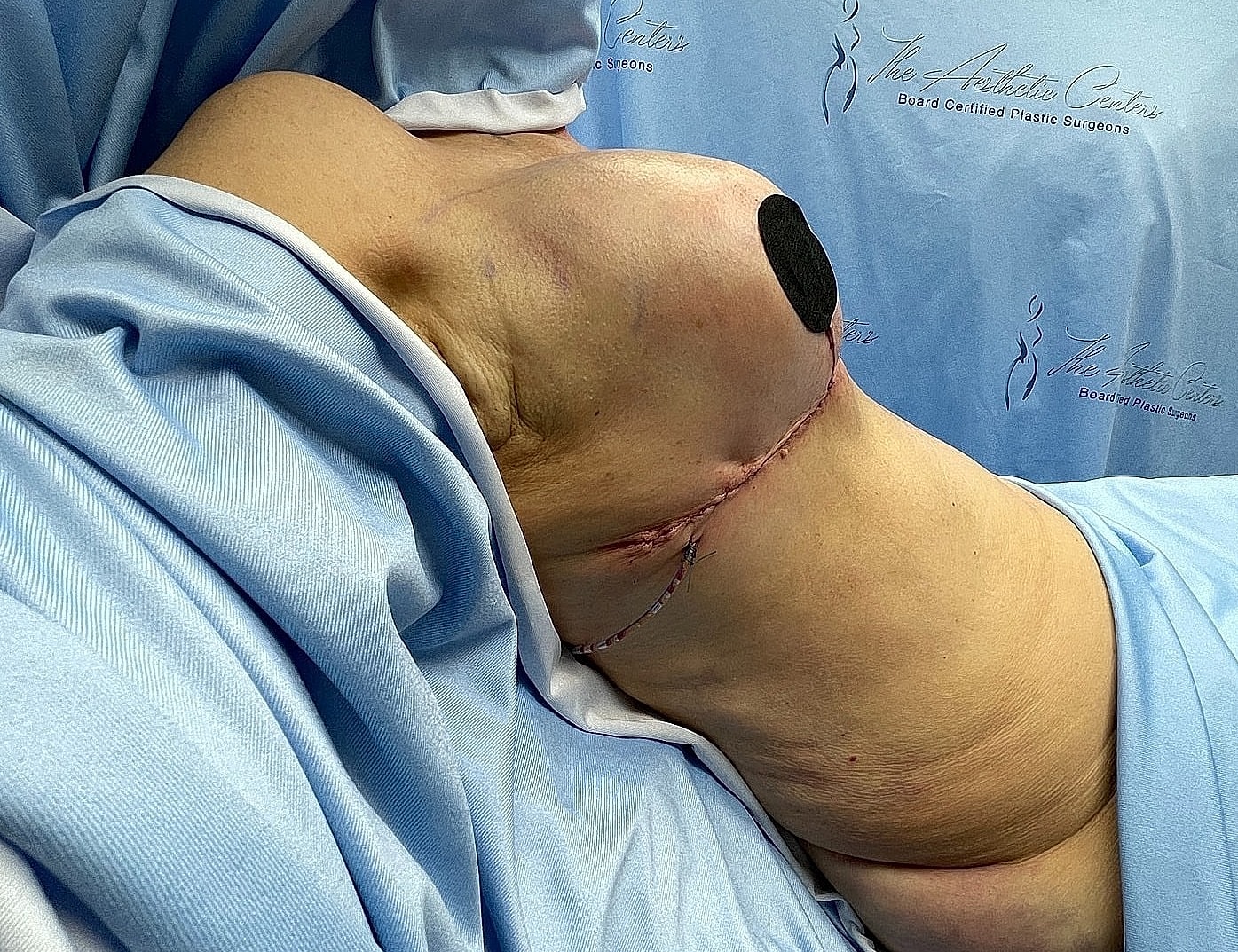 Post-surgery breast reconstruction recovery image.