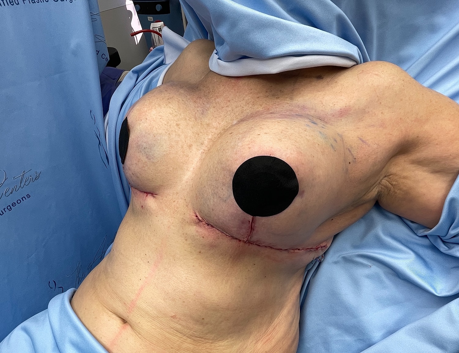 Post-surgery breast with recovery markings.
