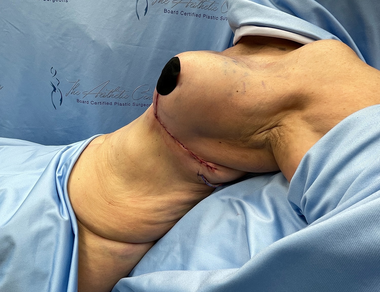 Post-operative breast surgery with visible stitches.