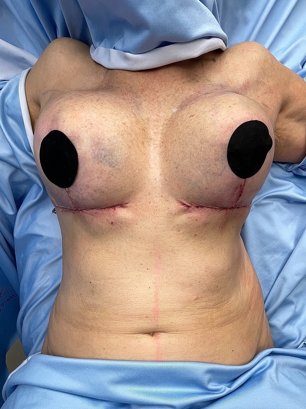 Post-surgery chest with bandages and markings.