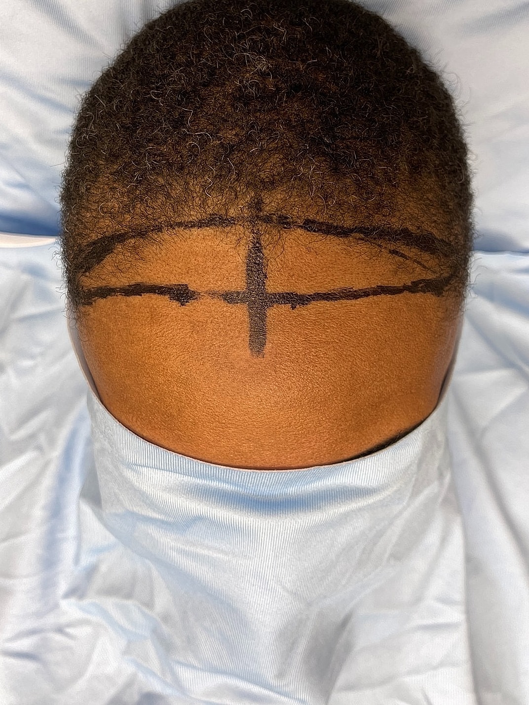 Head with markings on scalp for procedure.