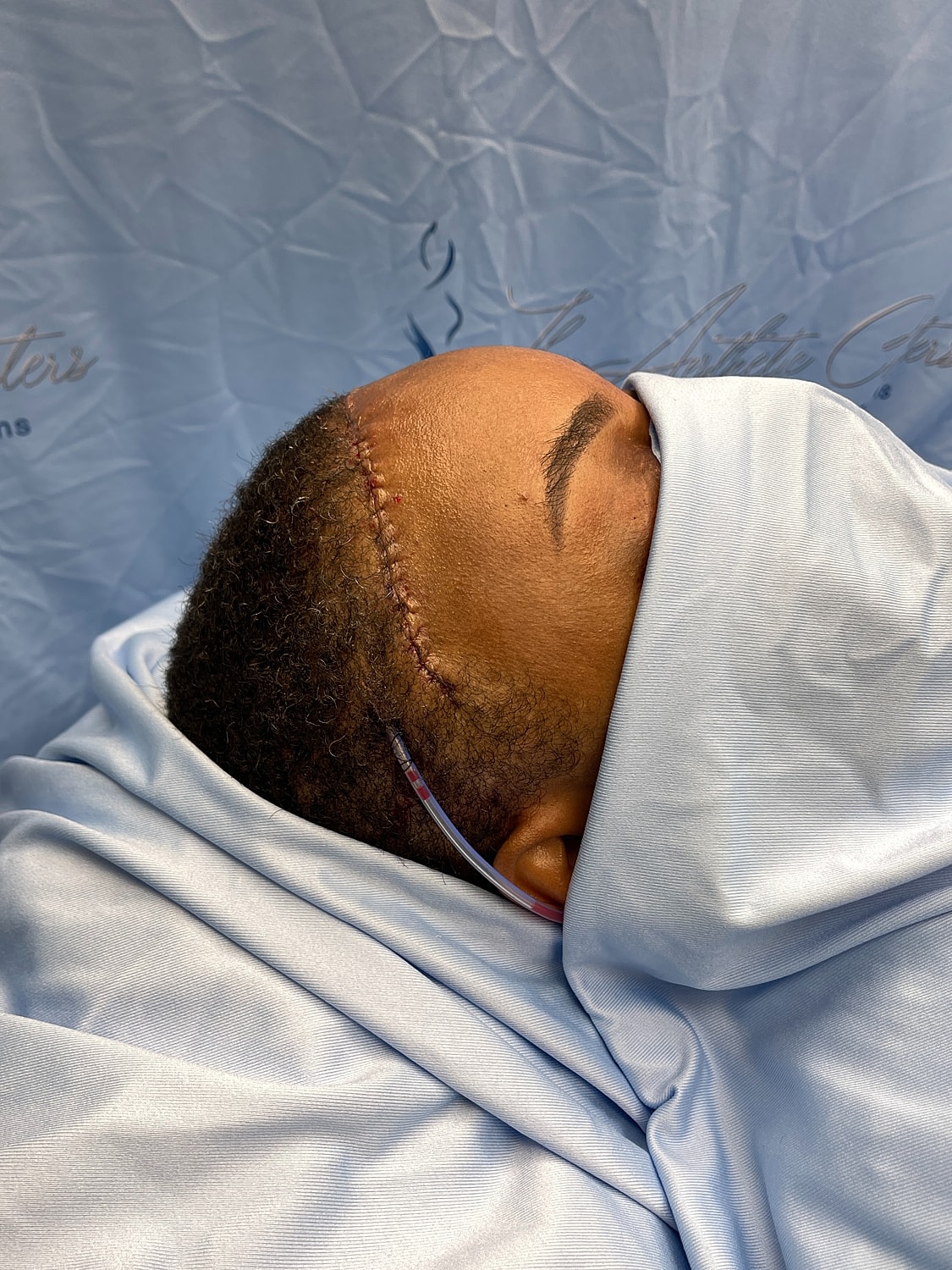 Patient recovering with surgical incision on scalp.