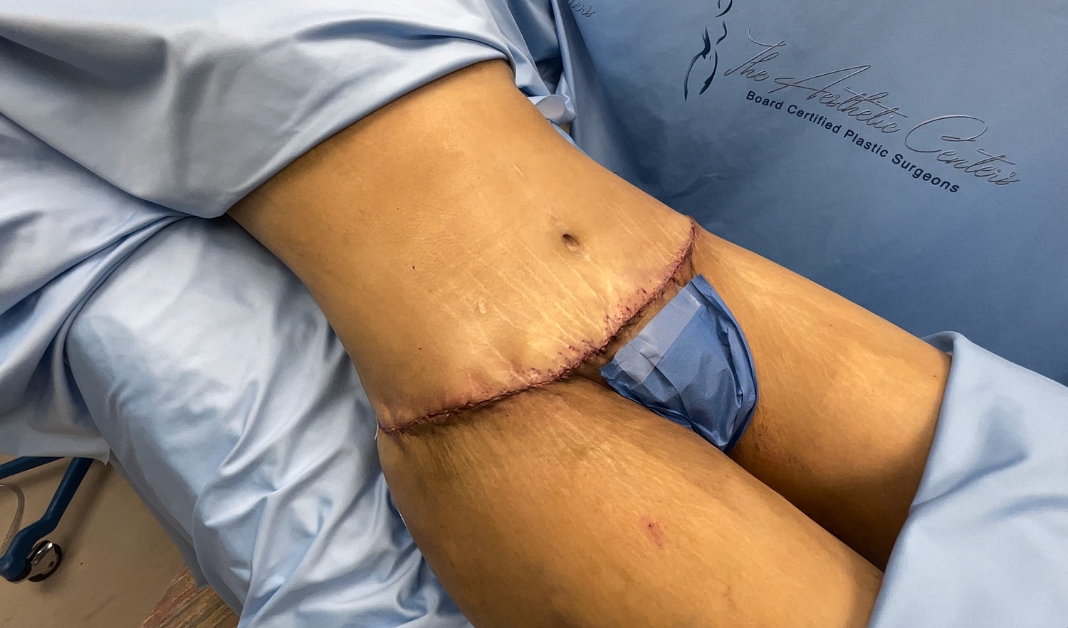 Surgical site on abdomen with healing stitches.