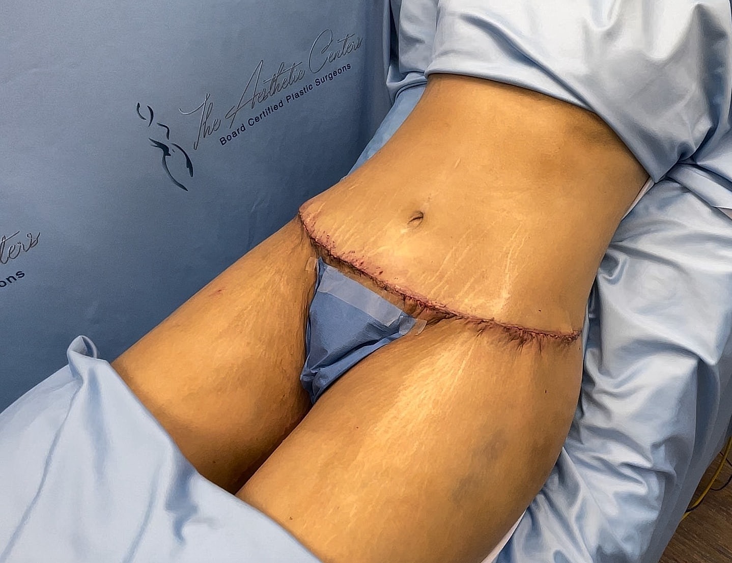 Post-operative view of abdominal surgery site.