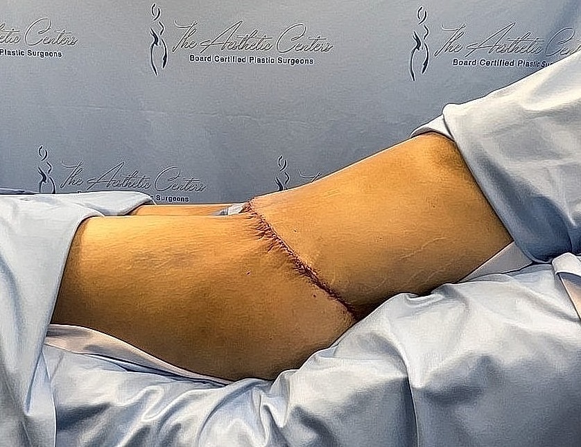 Surgical scar on patient’s arm post-operation.