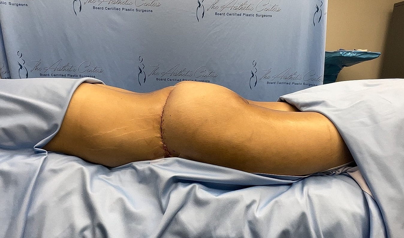 Surgical patient on table post-operation in clinic.