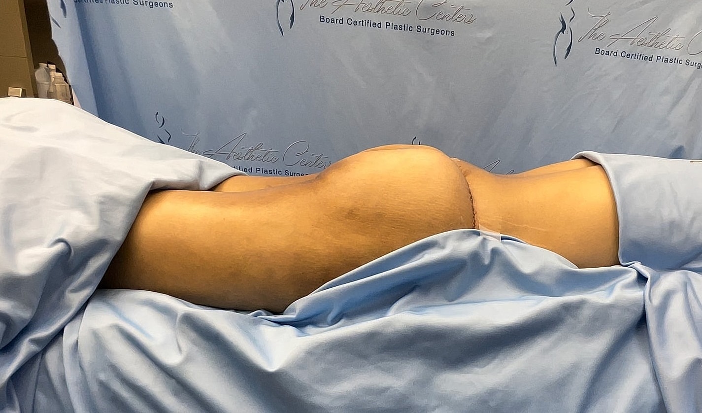 Patient lying on table post-surgery, covered.